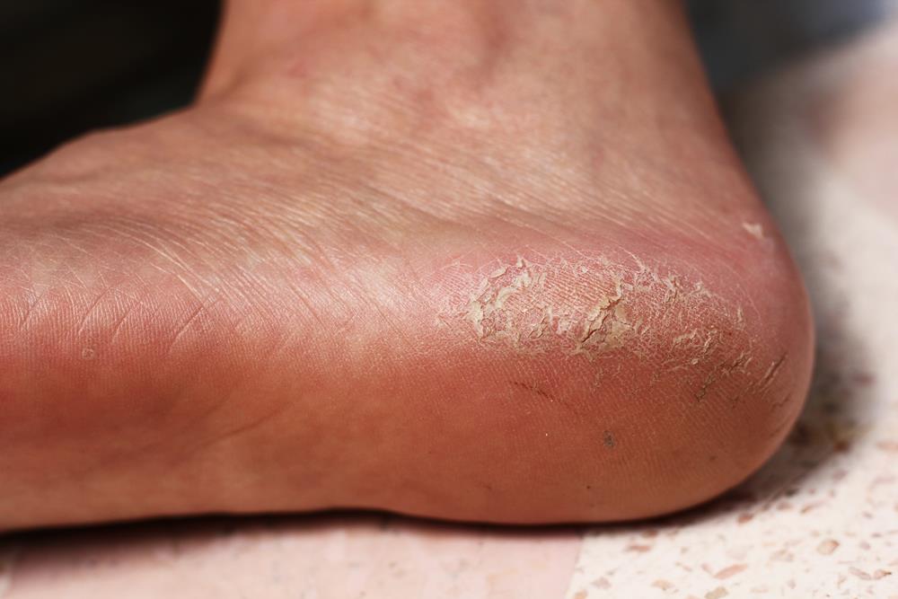 Calluses Simi Valley, CA